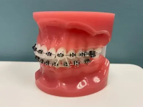 A dental model of teeth with orthodontic braces attached.
