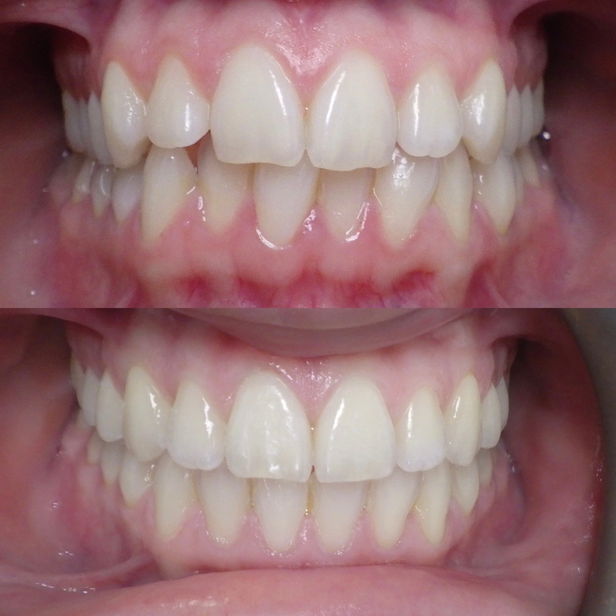 braces to perfect a smile