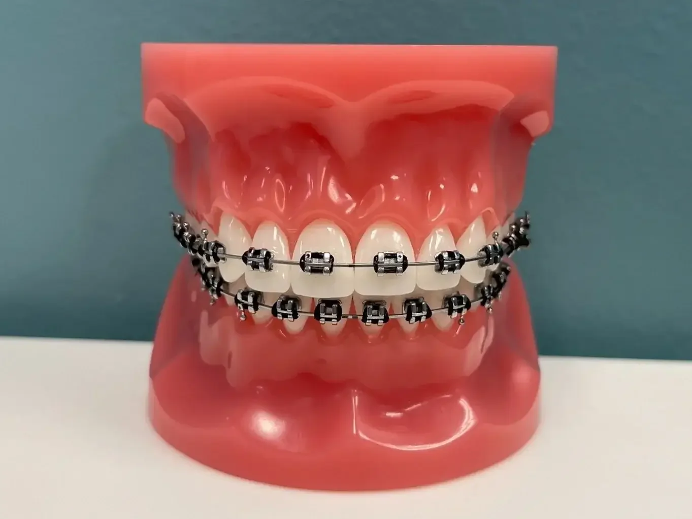 A dental model of a mouth with orthodontic braces on the teeth.