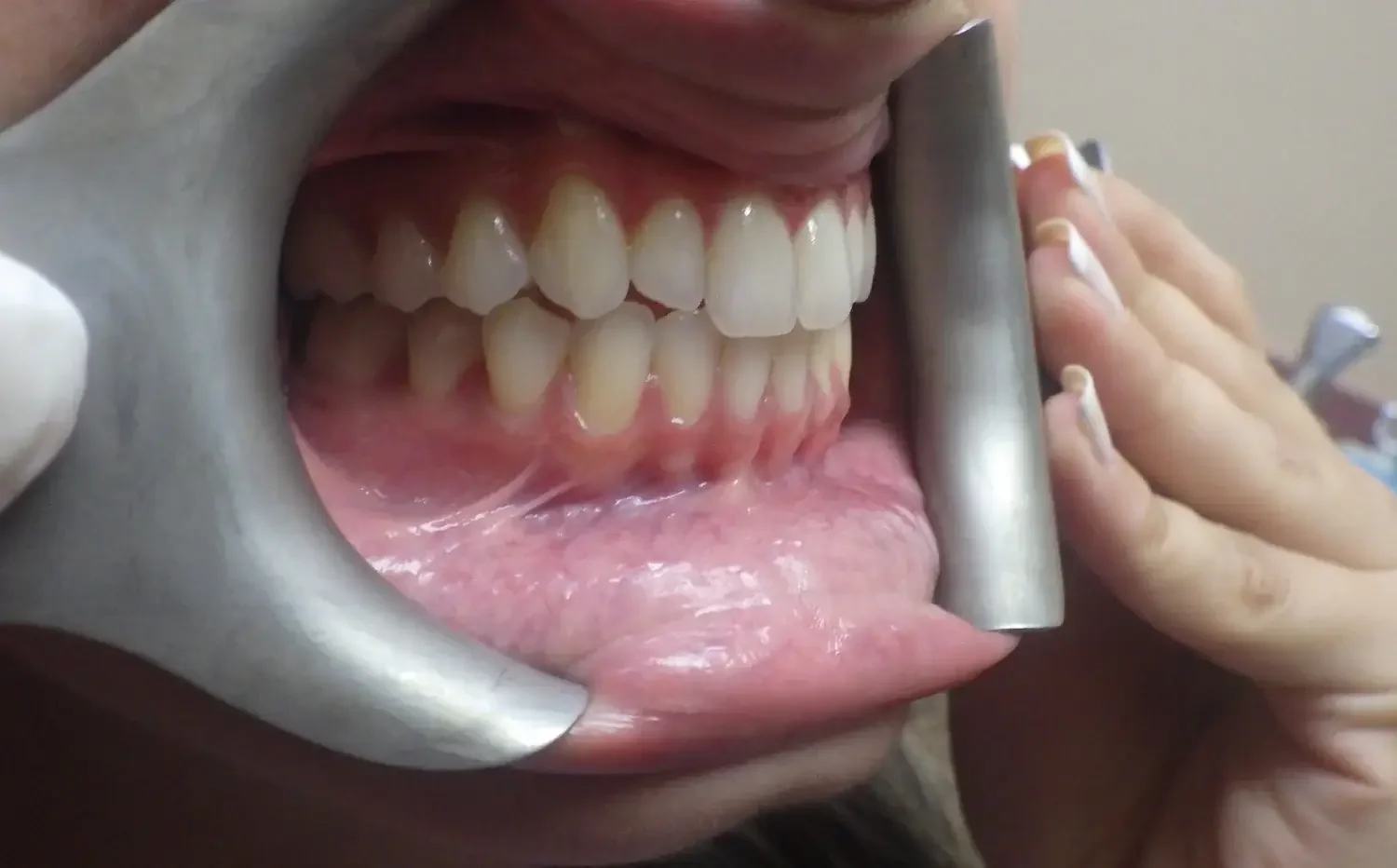 Close-up of a person's mouth held open with a dental device, showing upper and lower teeth, gums, and tongue.