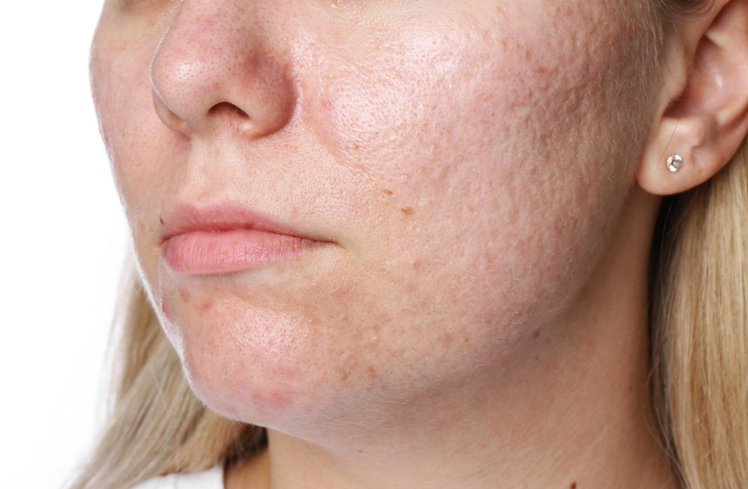 ¿Piel estresada? Señales comunes y cómo recuperarla con hábitos, nutrición y tratamientos no invasivos