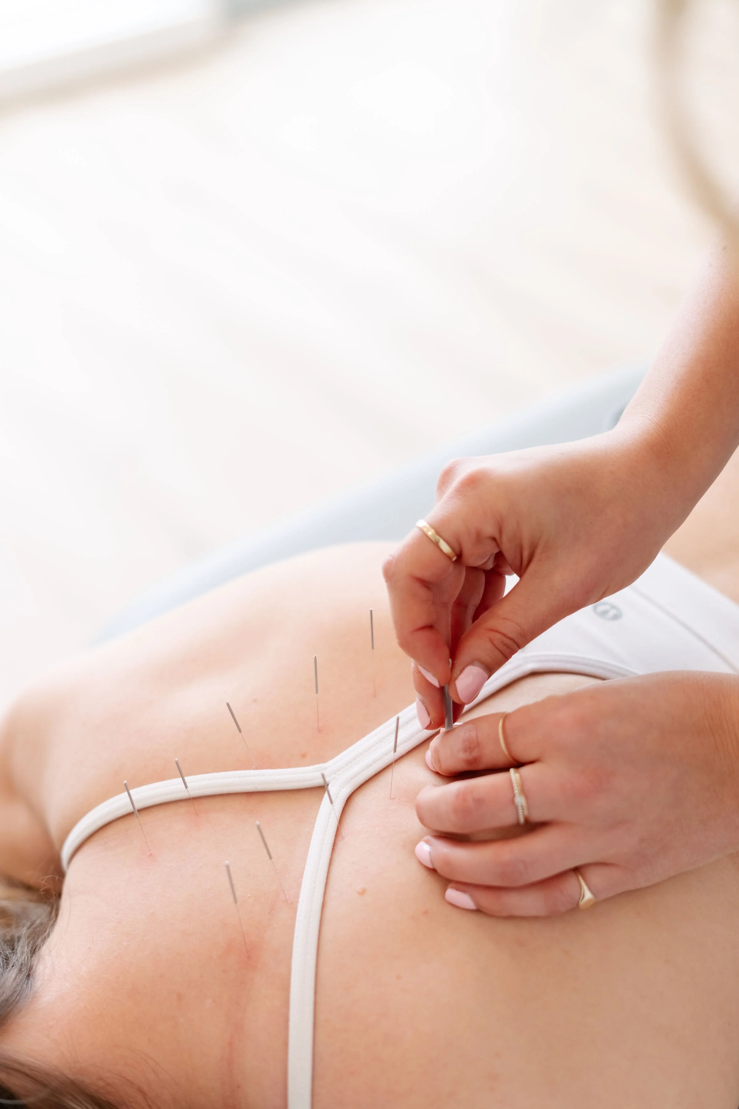 acupuncture being performed on girls back in stoney creek ontario at the wellness hub