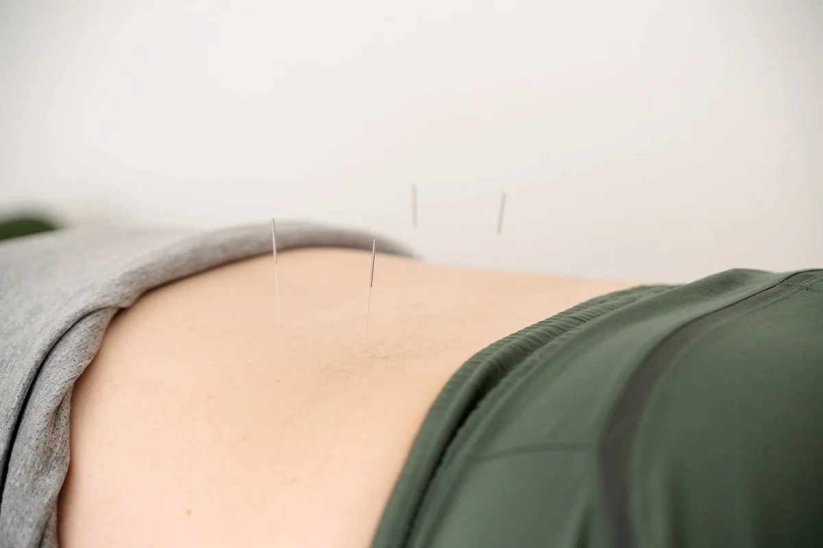 Acupuncture treatment on upper back at The Wellness Hub clinic in Stoney Creek Ontario