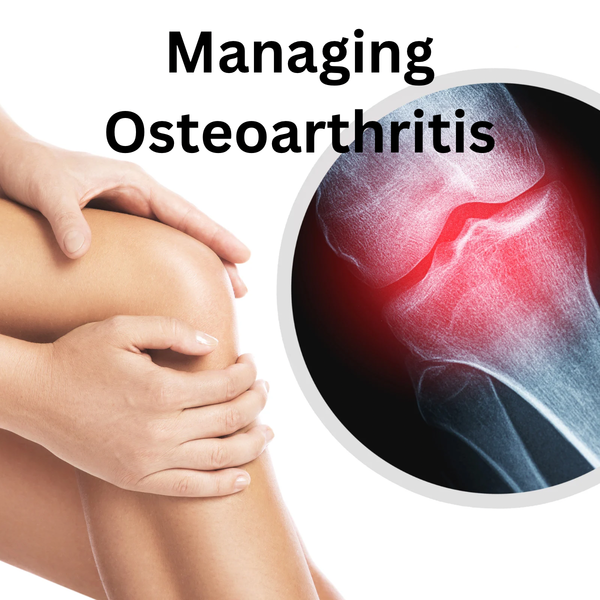 Managing Osteoarthritis: An Approach That Can Be a Game Changer