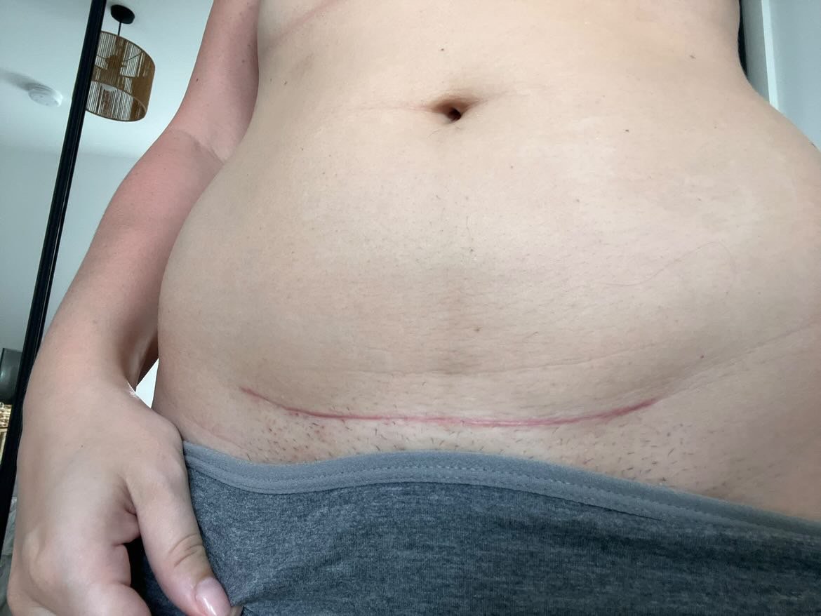 6-8 Week Scar Check: C-sectionUK Research Results