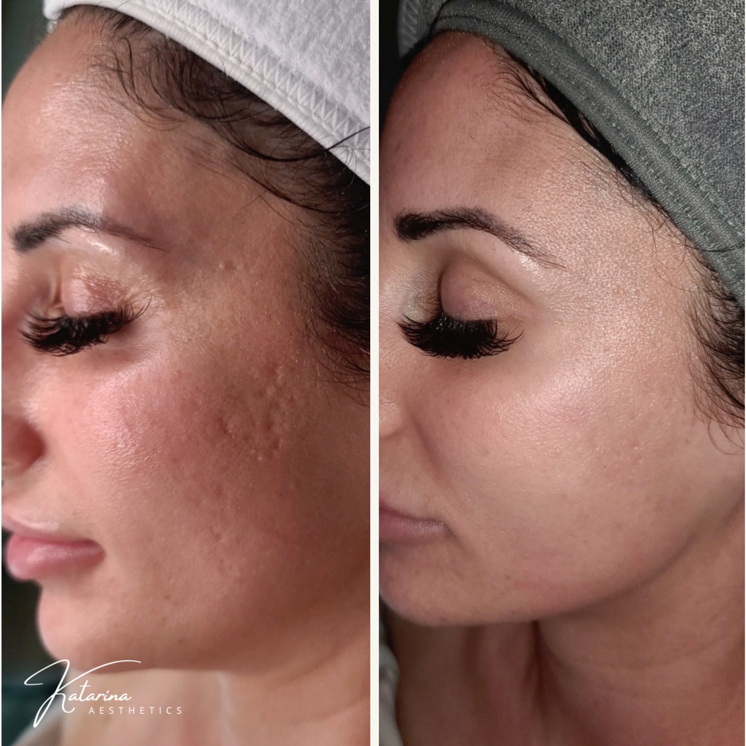 healing acne scars, how to get rid of acne scars, your honest glow, skincare routine, healthy skin tips, holistic skincare, natural skincare