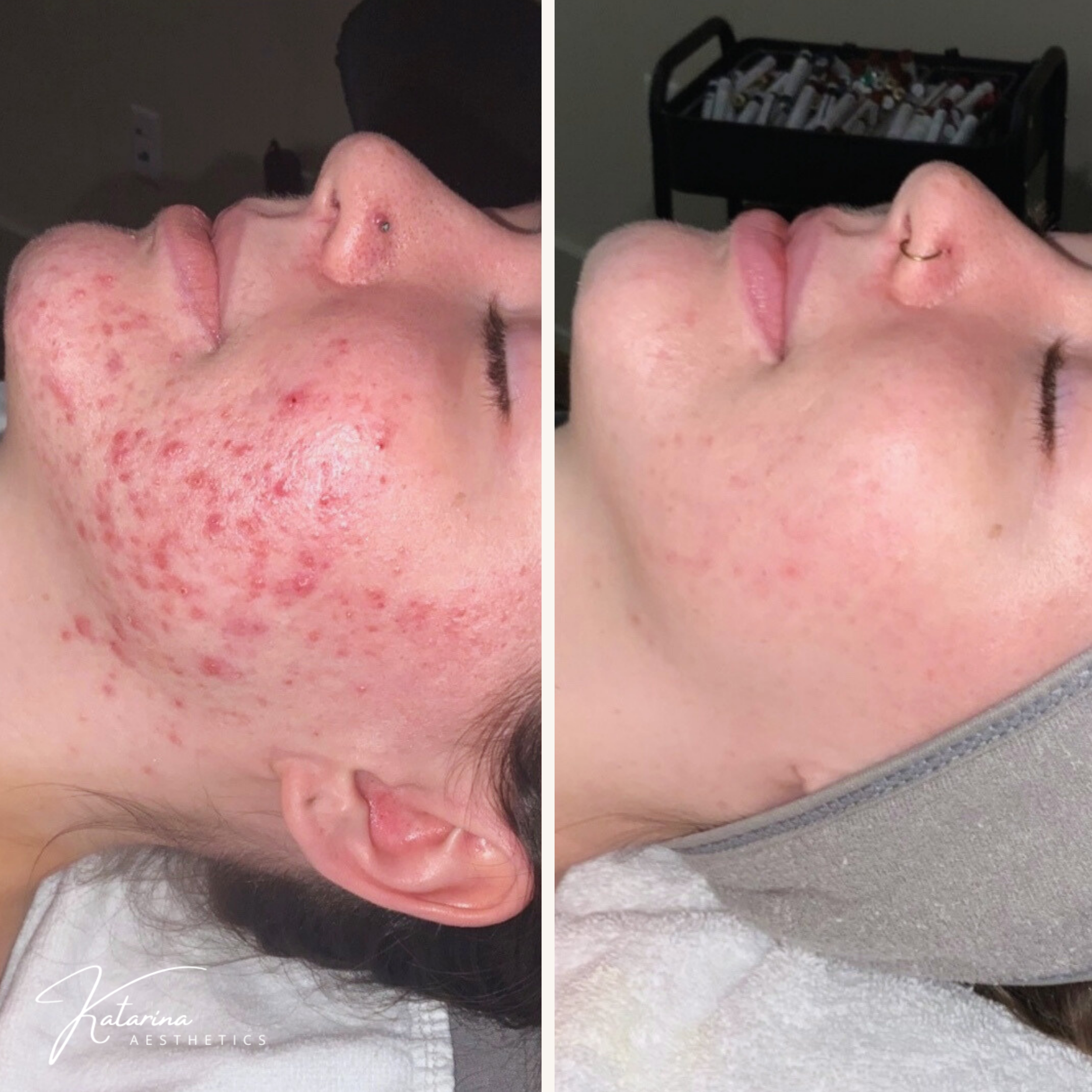 acne facial, acne skincare routine, your honest glow