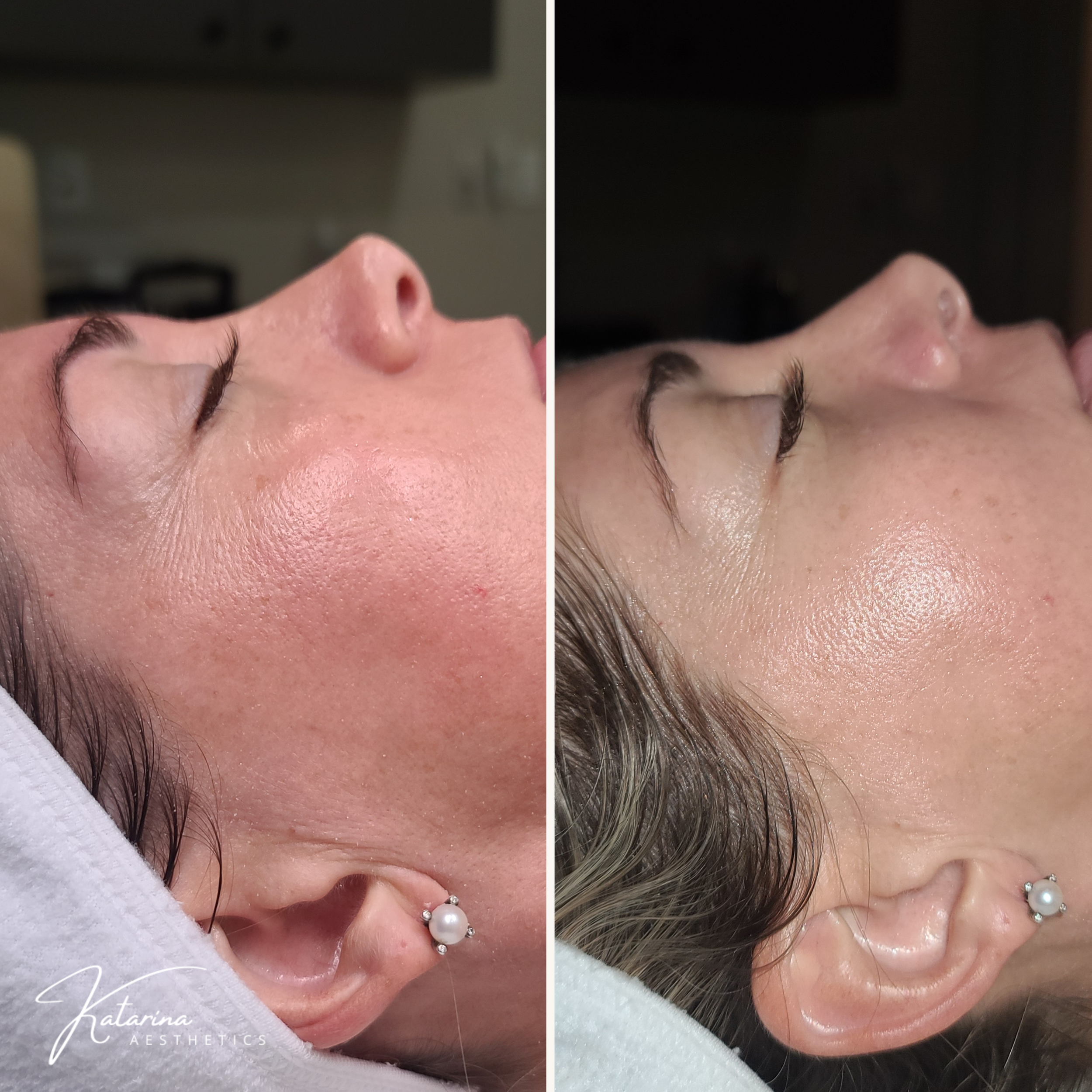 your honest glow, before and after face massage, before and after facial, skincare routine, Brightening serum for hyperpigmentation – Vitamin C skincare treatment