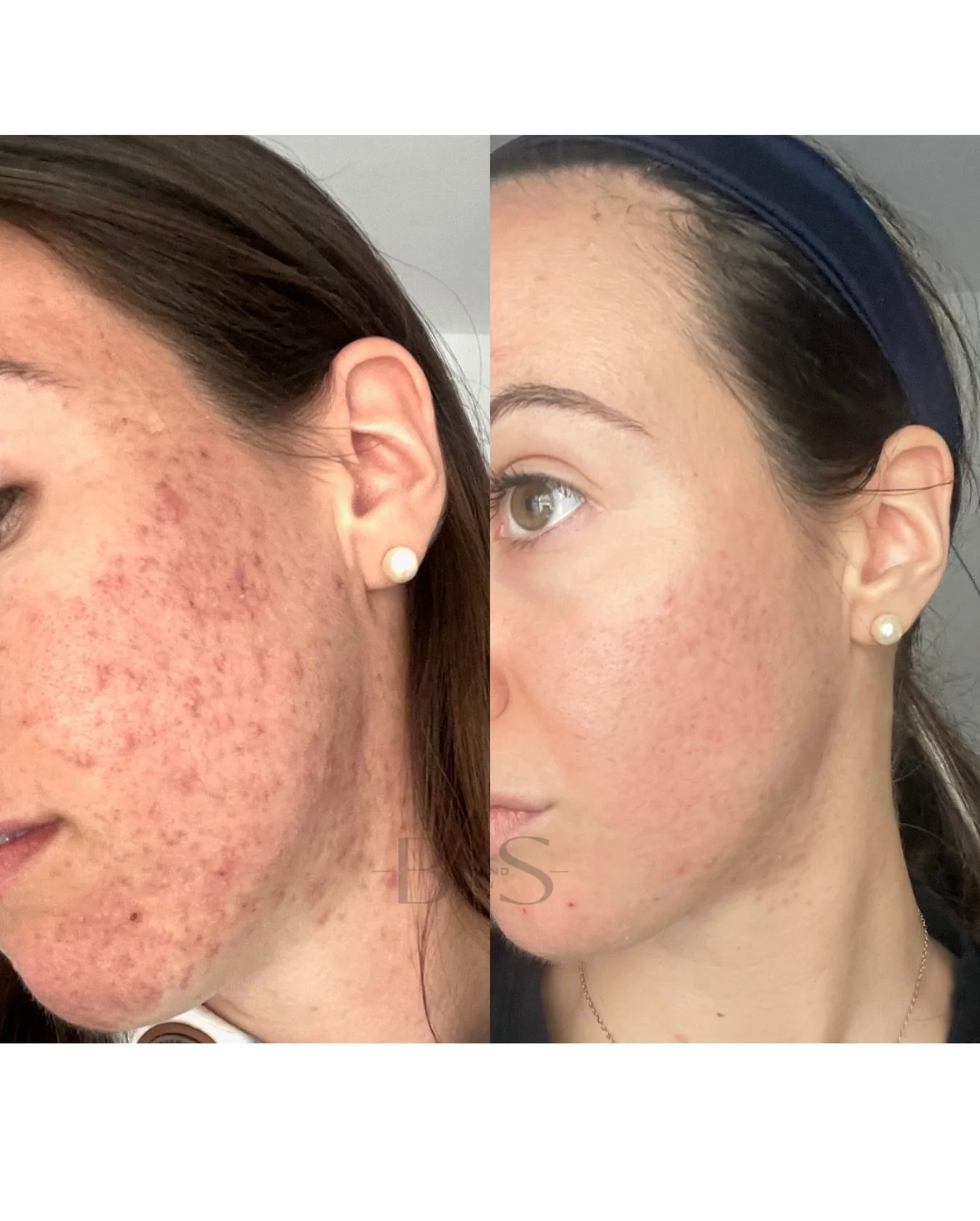 🔹 Struggling with Acne? This Could Be You! 🔹

My client battled acne for years&mdash;trying everything with little success. But once we created a personalized treatment plan and paired it with the right skincare routine, everything changed. Just lo