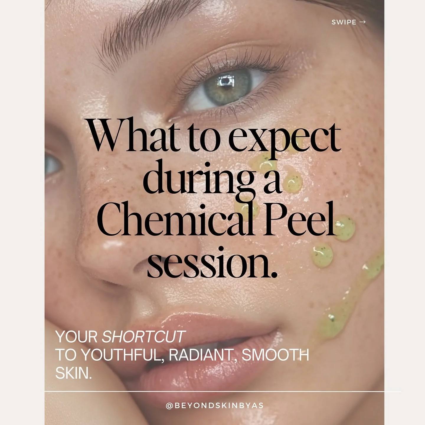 ➡️ Why Chemical Peels Are Your Skin&rsquo;s Best Anti-Aging Ally ✨

When it comes to reversing signs of aging, chemical peels are one of the safest and most effective treatments available&mdash;outperforming lasers in safety and long-term benefits! H