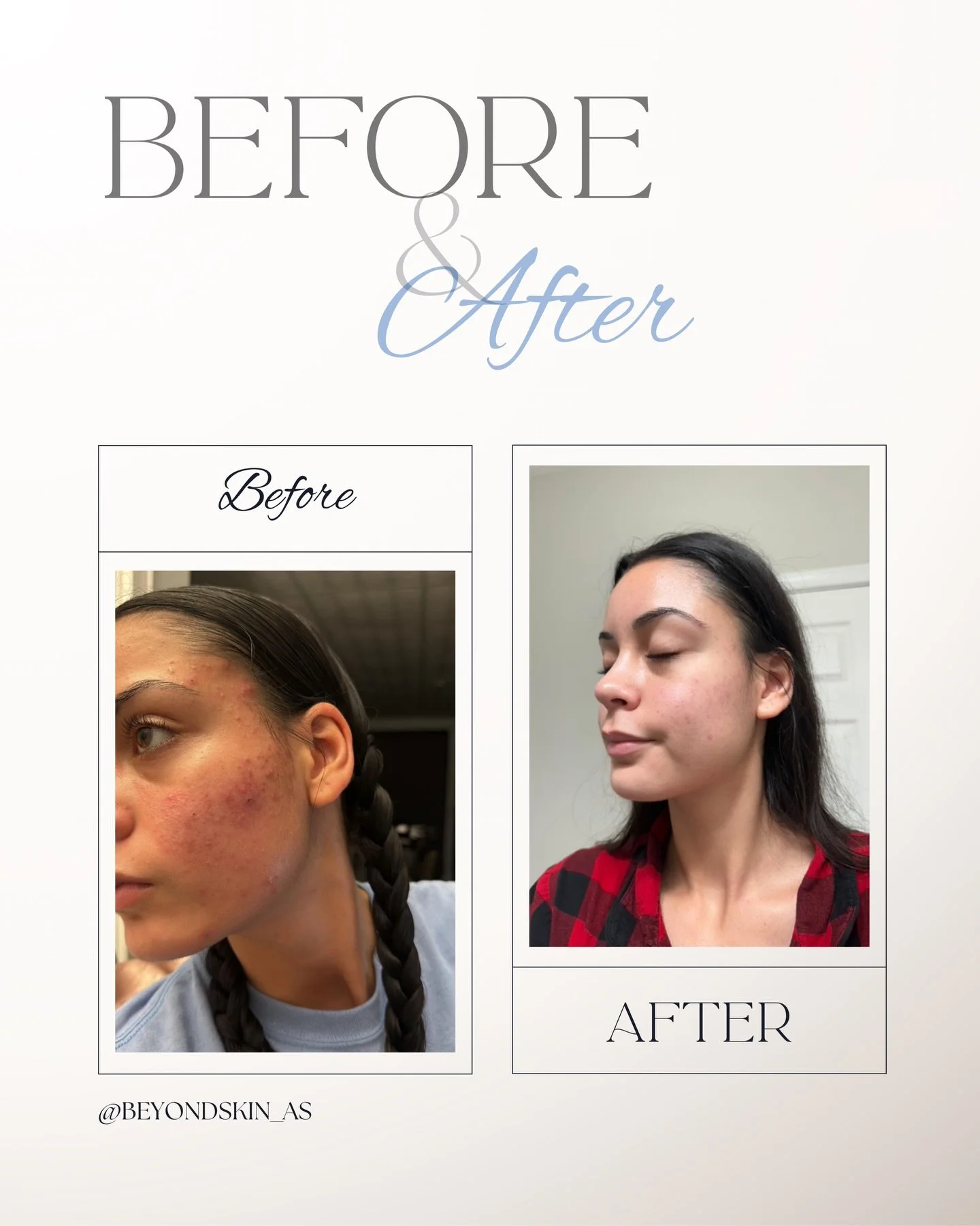 First, I want to say how truly grateful I am to this beautiful client for trusting me&mdash;not only with her skin, but also with sharing her journey so others can feel seen and understood. 🤍

Acne after stopping birth control is more common than yo