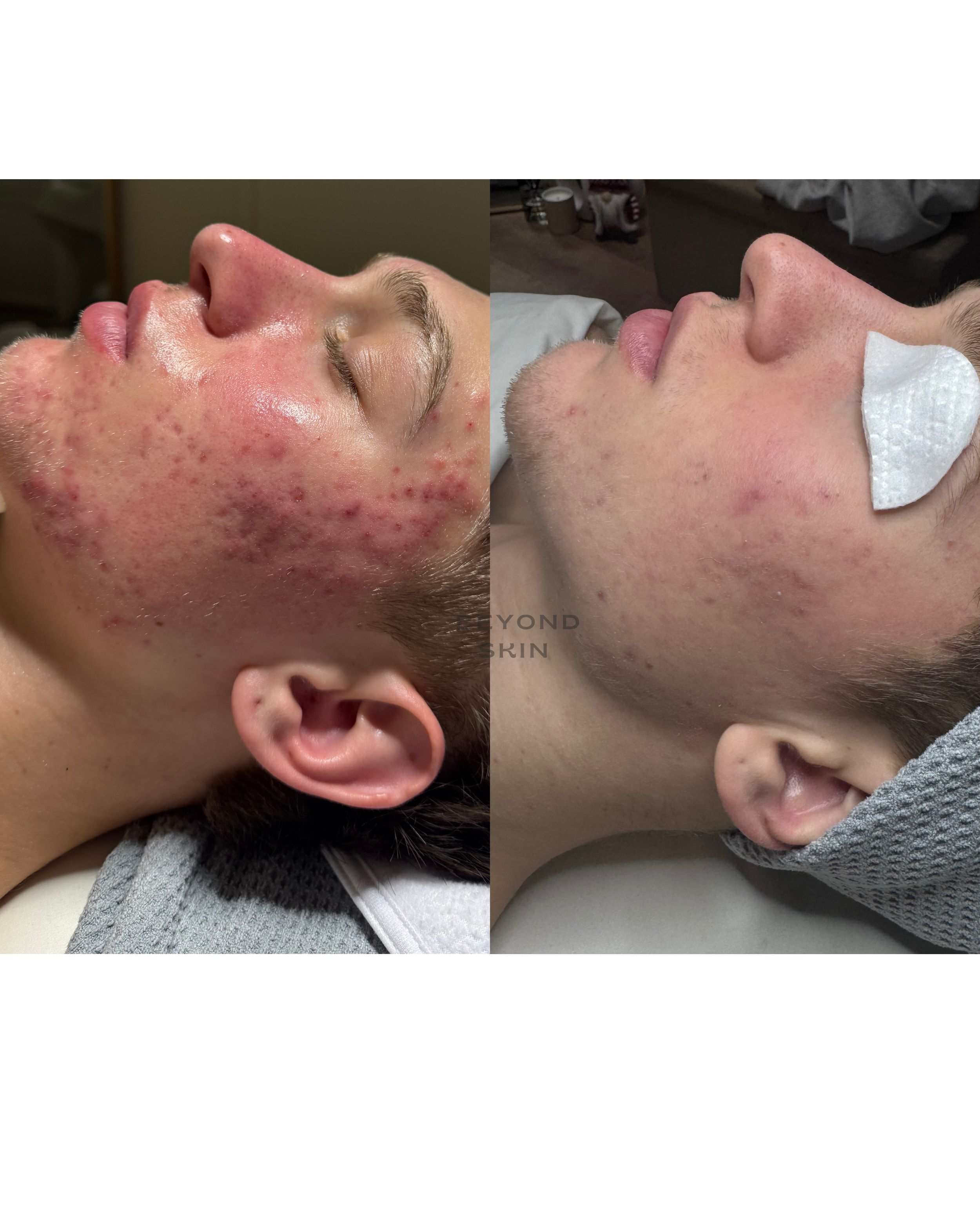 Side-by-side comparison of a man's face before and after a skincare treatment, showing improvements in acne and redness.