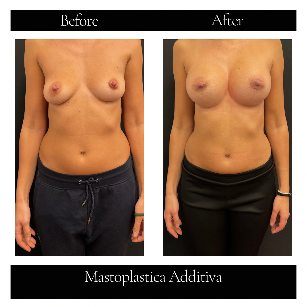 Mastoplastica Additiva 2.png