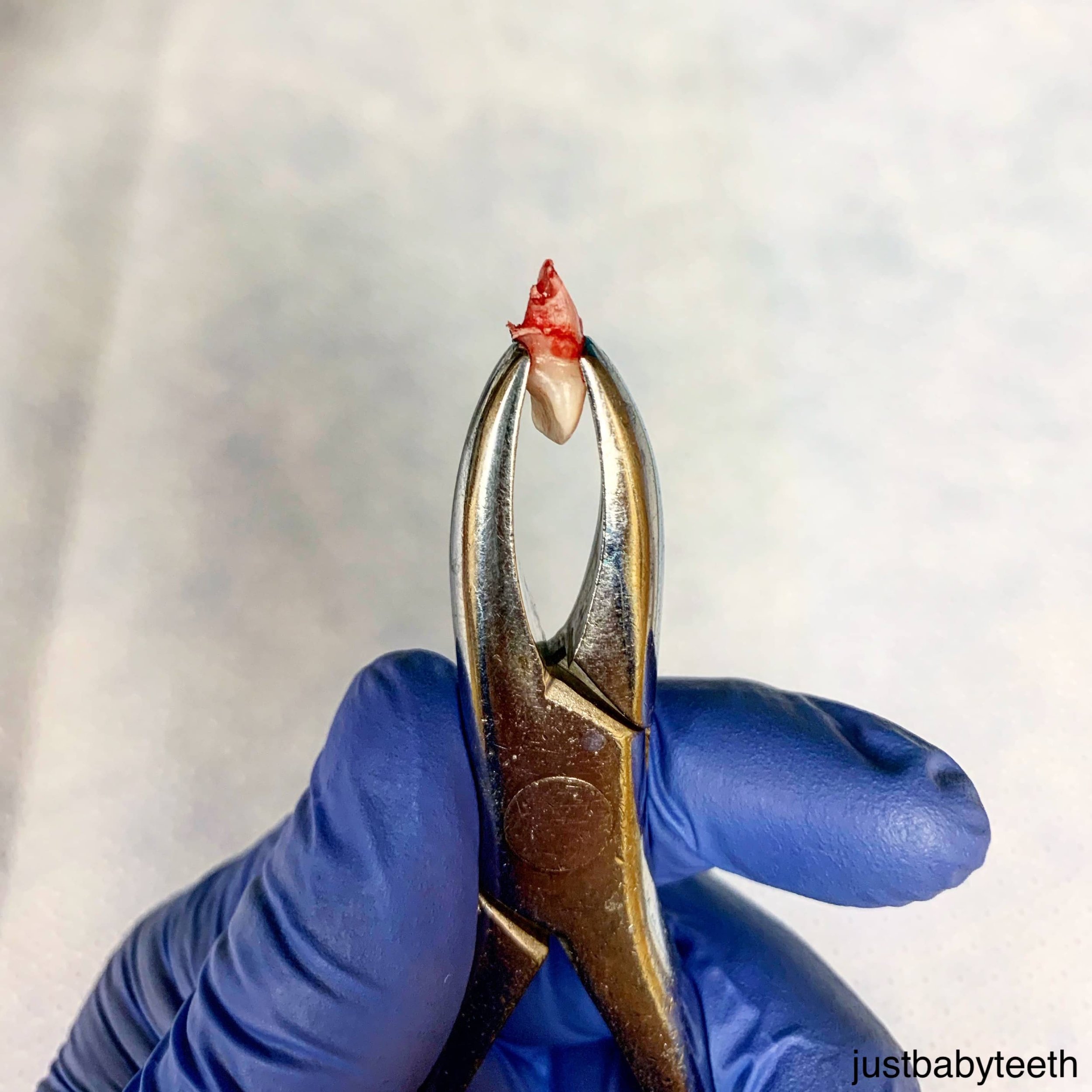  extracted primary incisor in forceps 