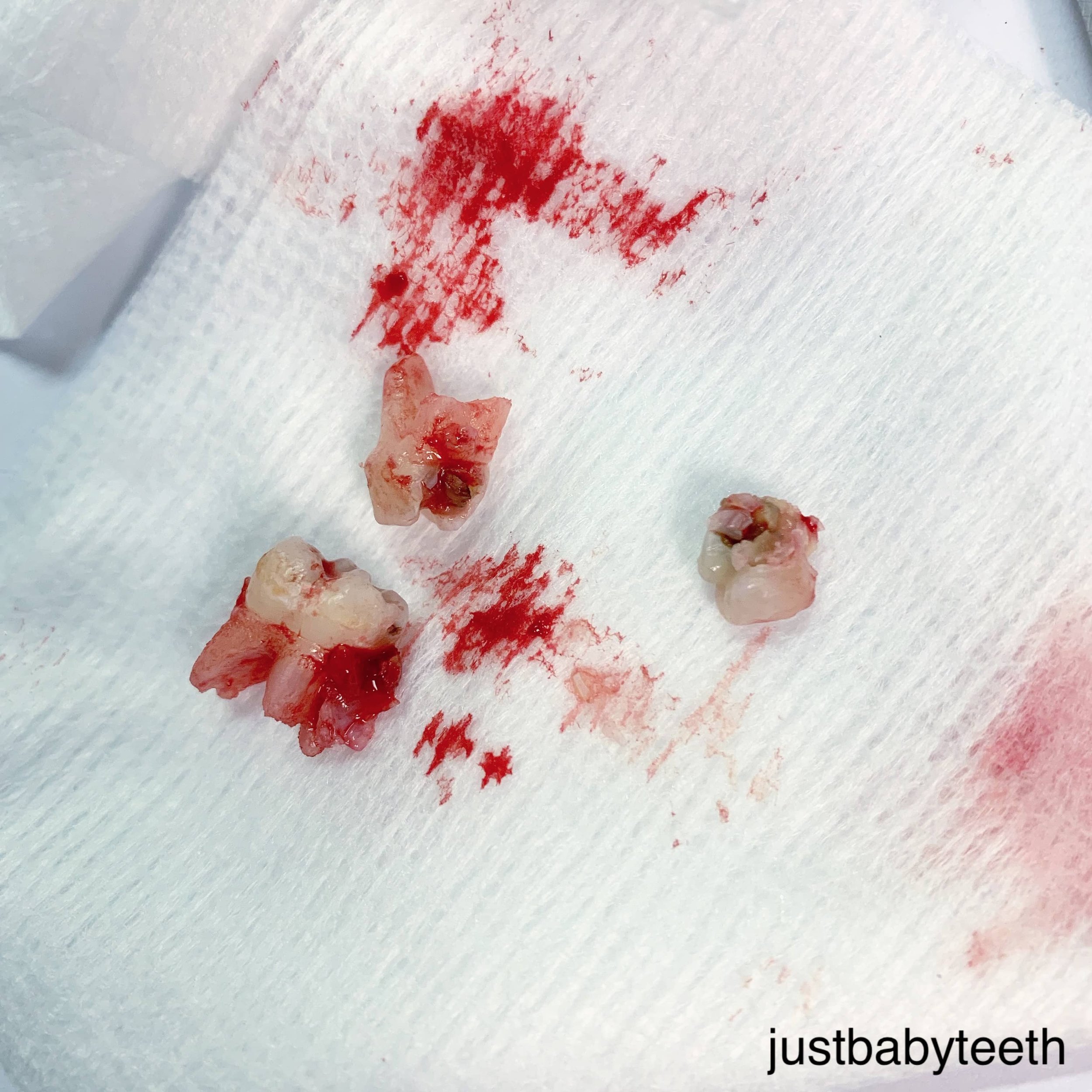  three extracted primary molars 