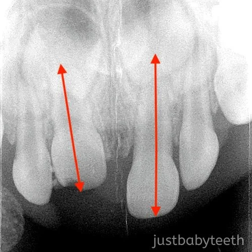 Tooth Intrusion Radiograph