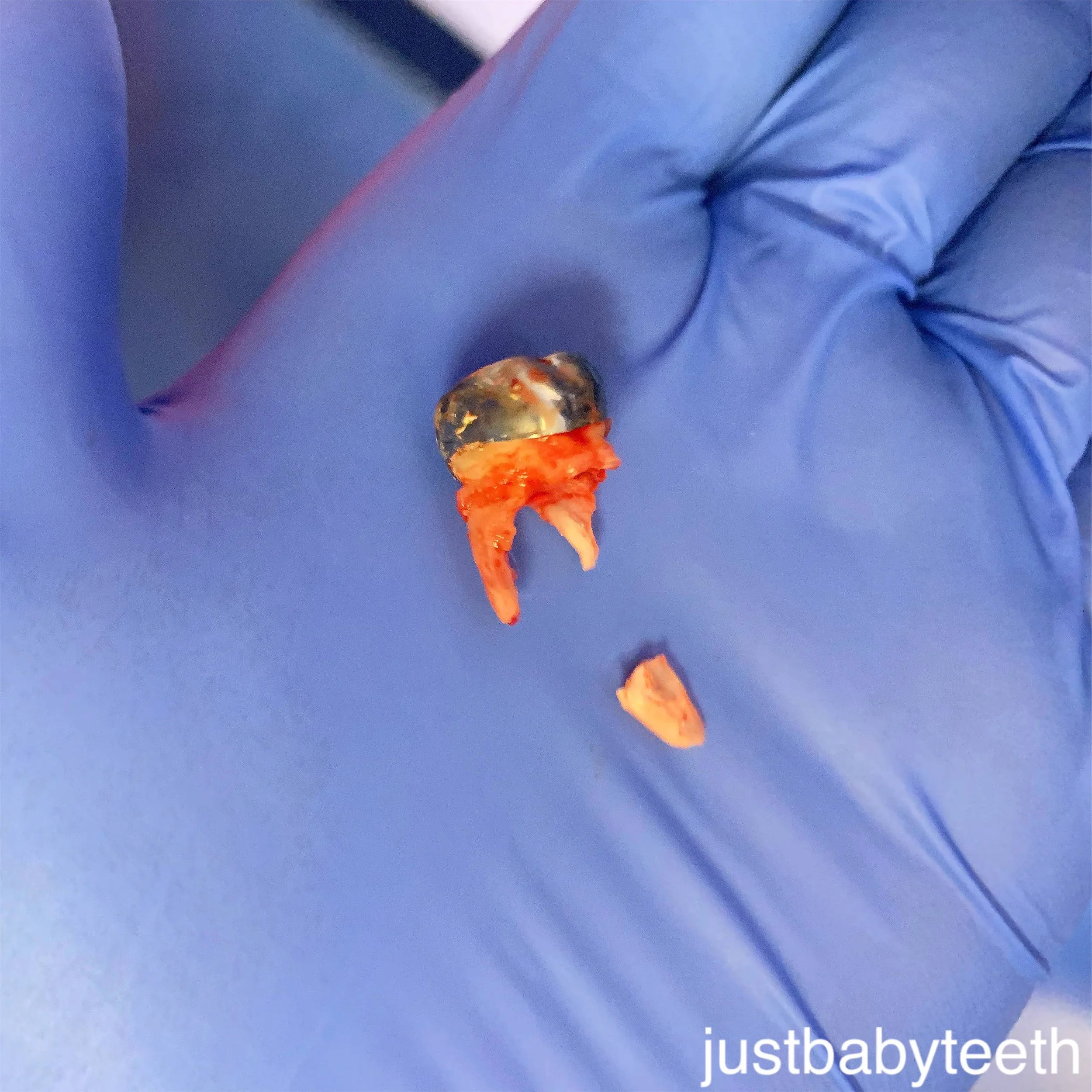  extracted #A with stainless steel crown and fractured root tip 