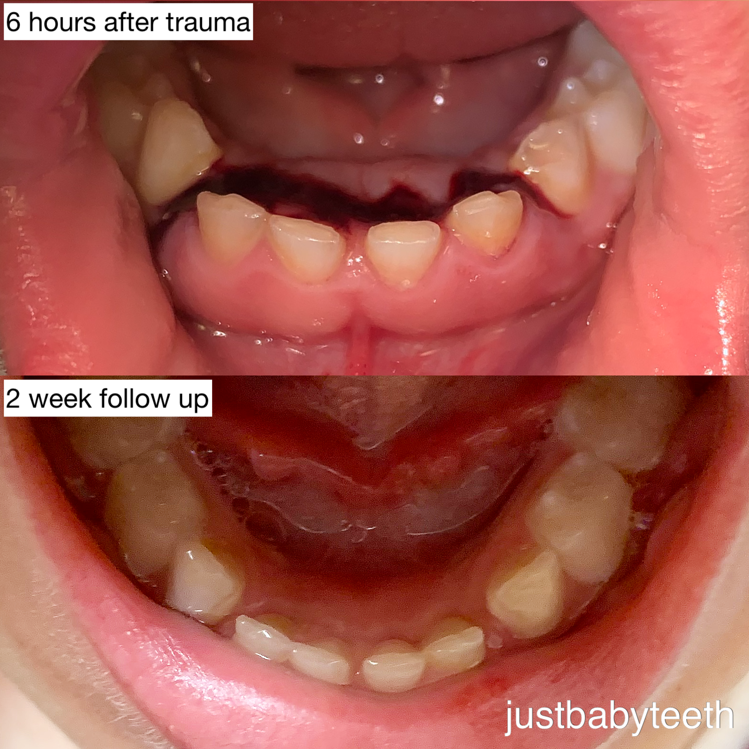 Alveolar fracture before and after healing