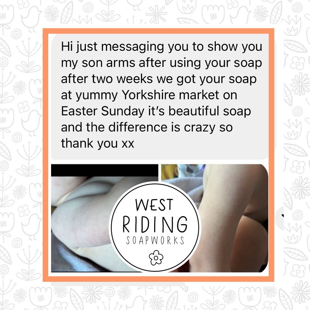 Sharing with kind permission from one of my lovely customer.

I hold a cosmetic assessment and make no medical claims. All I can say is that my products have been formulated to be super gentle using only natural skin loving ingredients. 

Receiving f