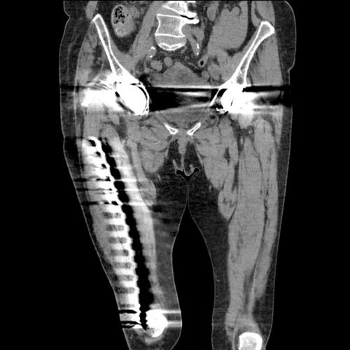 CASE 14: Revision of a recurrently dislocating hip with large ...
