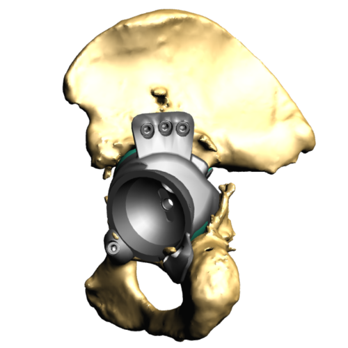 Implant+in+pelvis+front.png