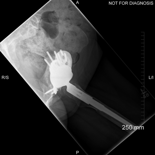 Post-op+radiograph+october+CTL+square.png