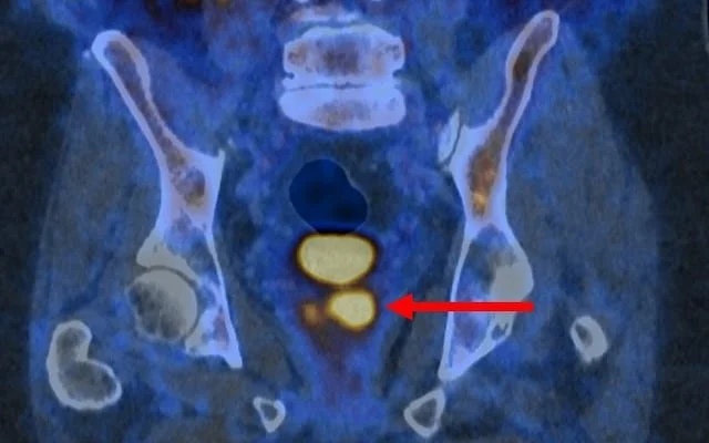 Prostate Cancer Diagnostic (US)