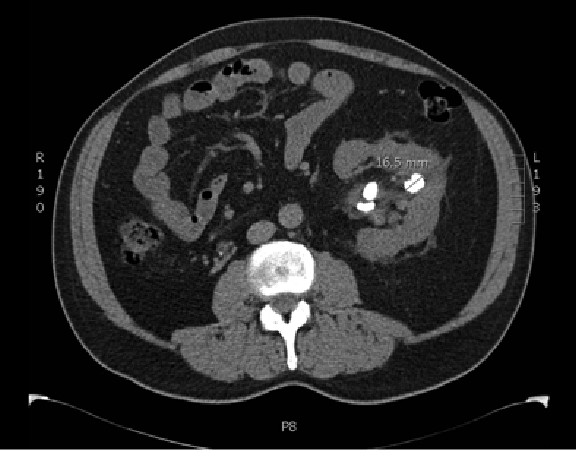 Kidney Stone Diagnostics