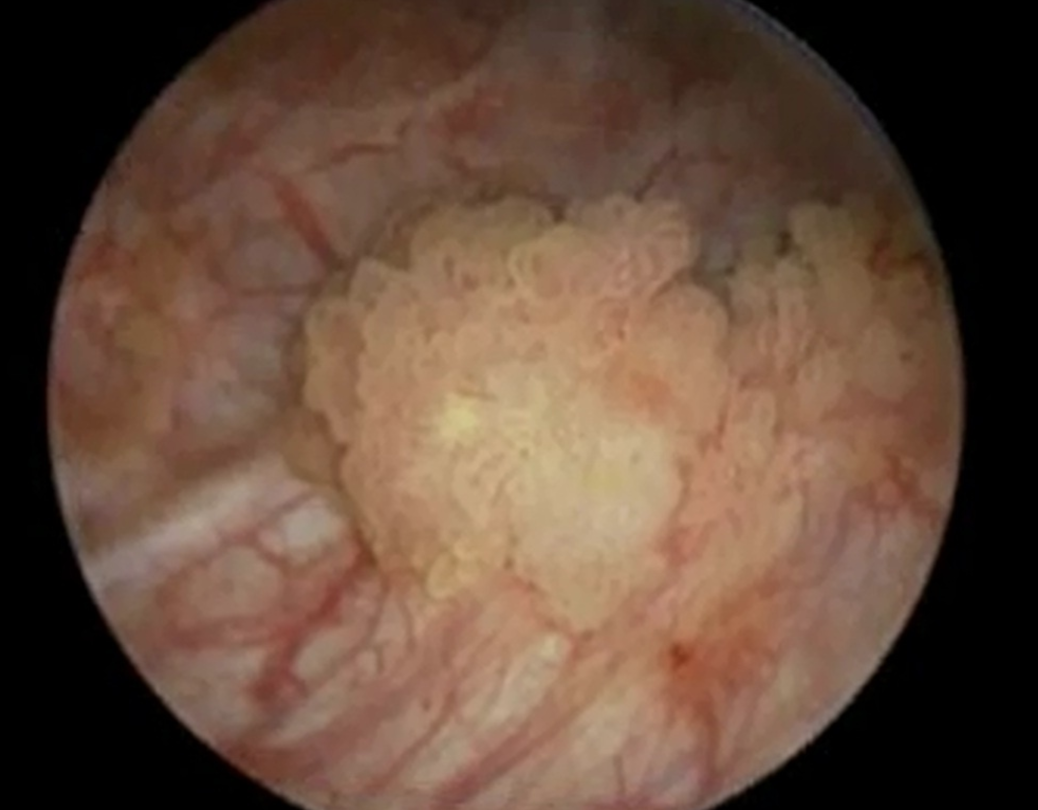 Bladder Cancer Diagnostic (US)
