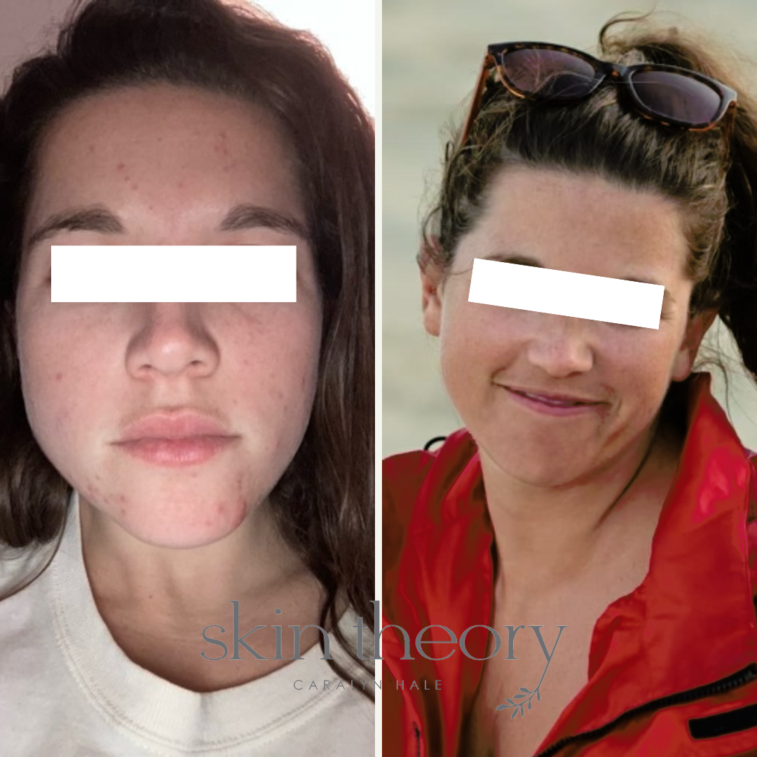 Caralyn Hale_Acne Clearing Results_2.png