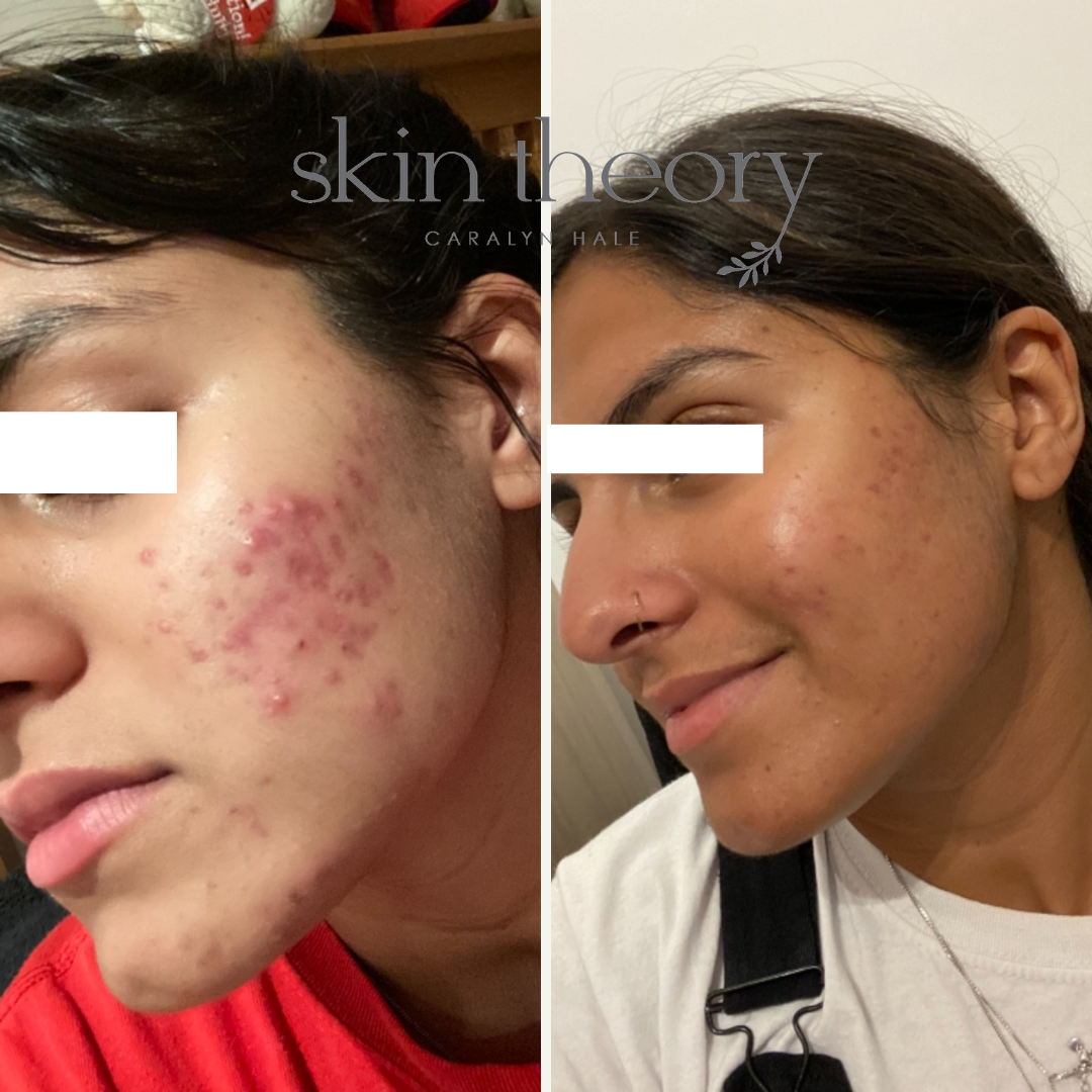 Caralyn Hale_Acne Clearing Results_1.png