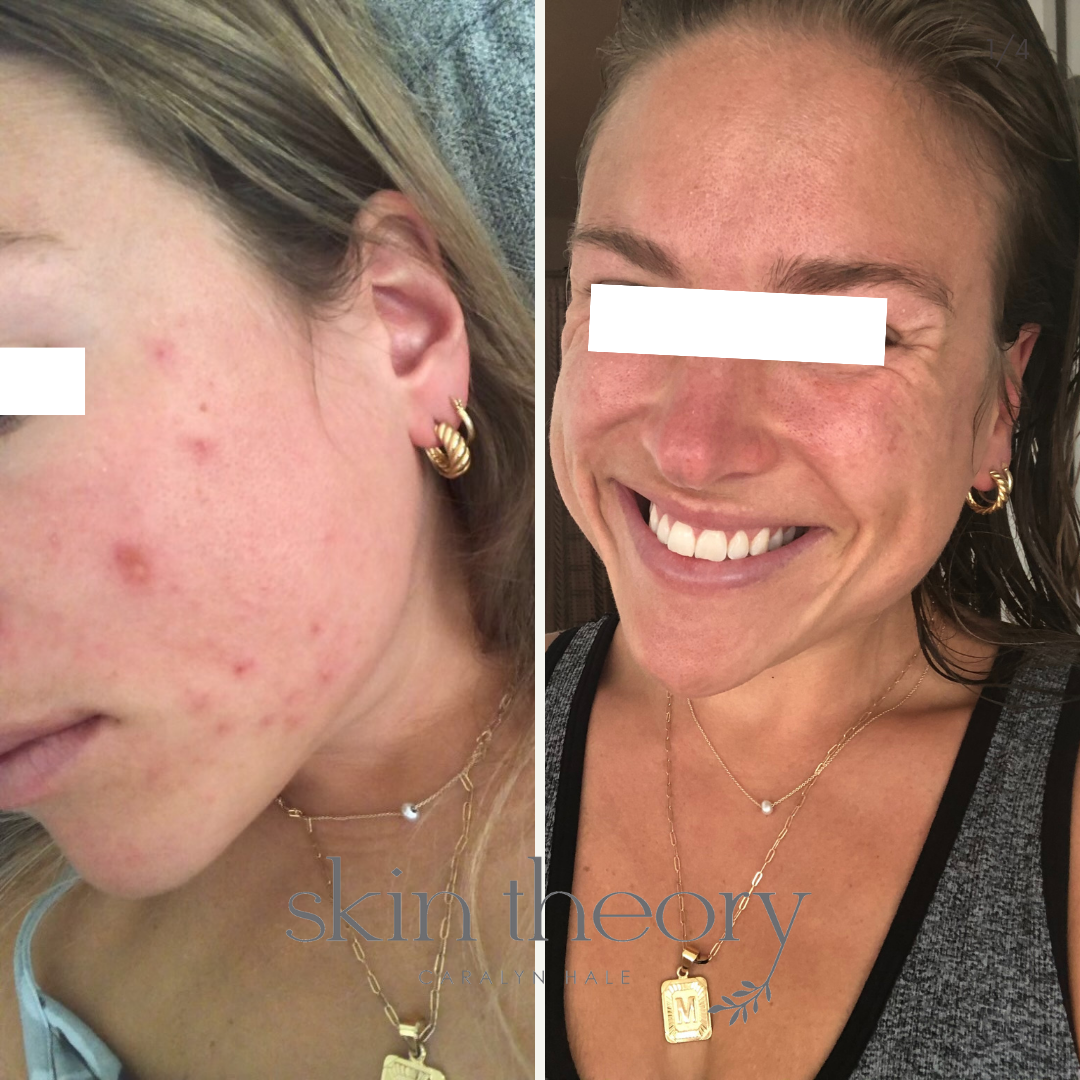 Caralyn Hale_Acne Clearing Results_3.png