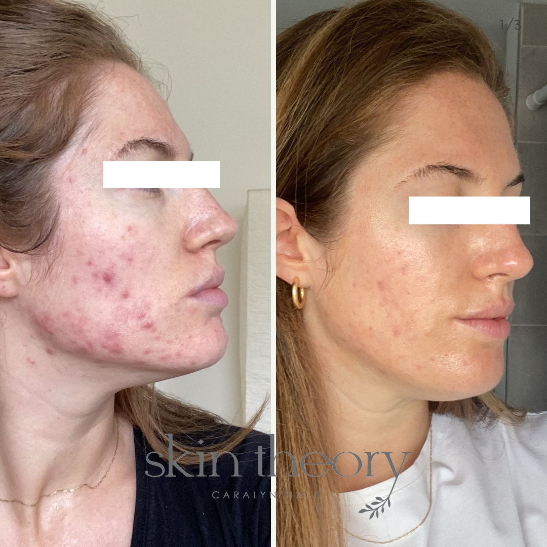 Caralyn Hale_Acne Clearing Results_4.png