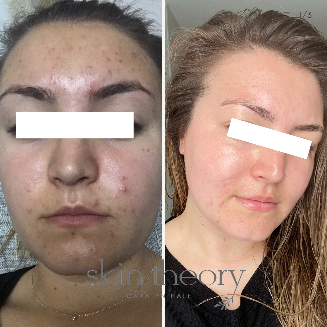 Caralyn Hale_Acne Clearing Results_5.png