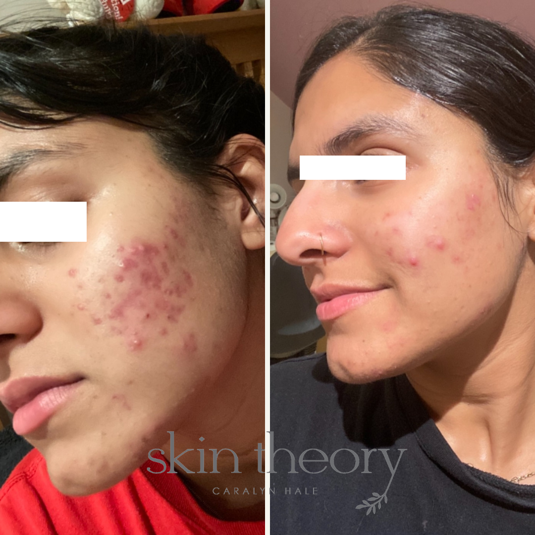 Caralyn Hale_Acne Clearing Results_6.png