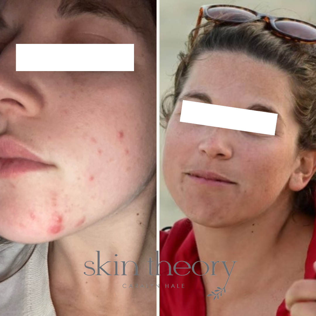 Caralyn Hale_Acne Clearing Results_7.png