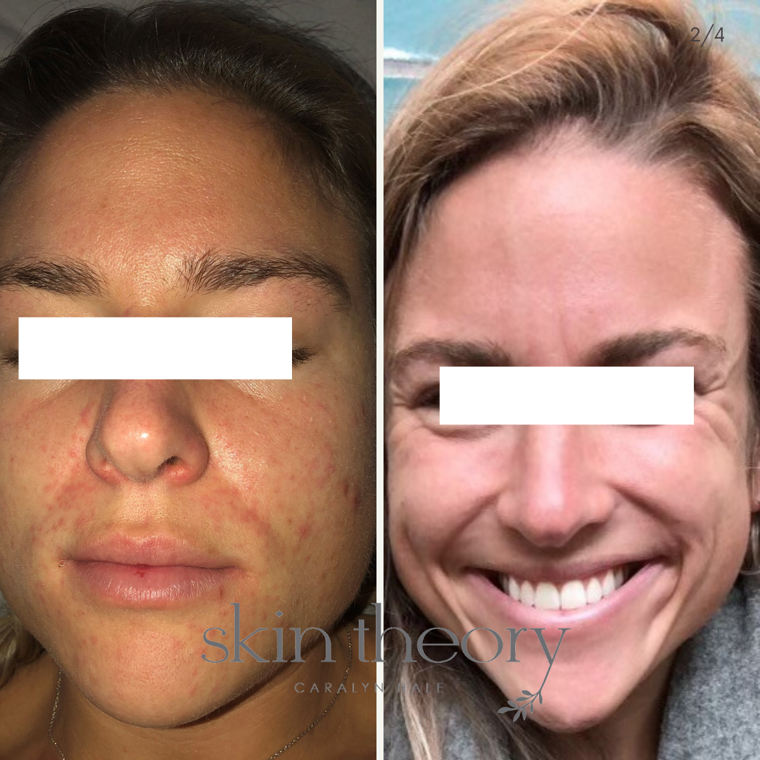 Caralyn Hale_Acne Clearing Results_8.png