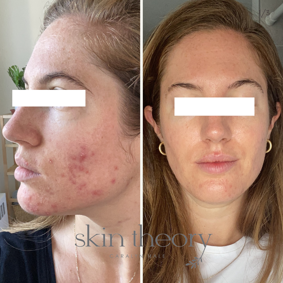 Caralyn Hale_Acne Clearing Results_9.png