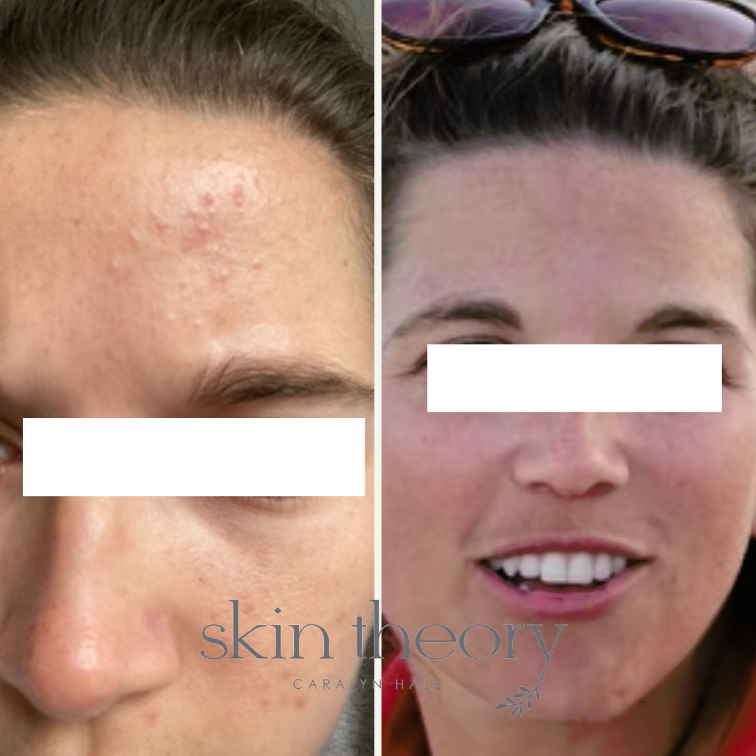 Caralyn Hale_Acne Clearing Results_10.png