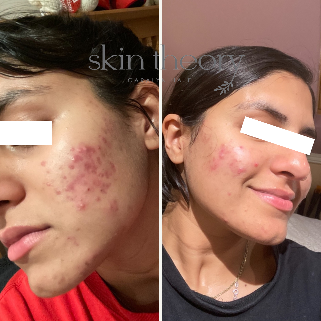 Caralyn Hale_Acne Clearing Results_11.png
