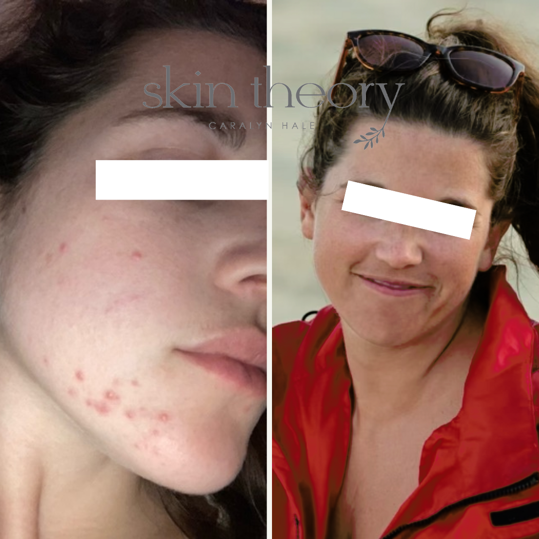 Caralyn Hale_Acne Clearing Results_12.png