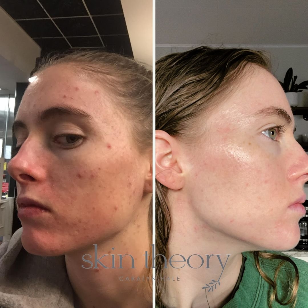 Caralyn Hale_Acne Clearing Results 2.jpg