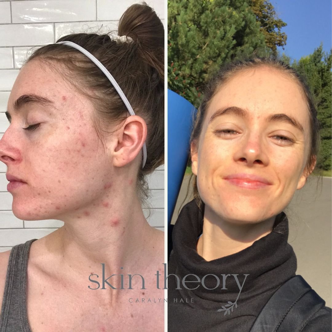 Caralyn Hale_Acne Clearing Results 3.jpg