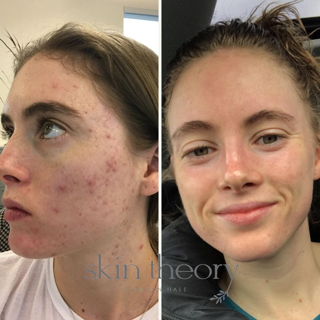 Caralyn Hale_Acne Clearing Results.jpg
