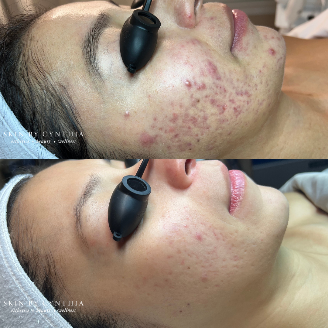 Acne Treatment, Acne Specialist, Acne Skincare, Acne-Prone Skin, Bay Area Skincare, Acne, Napa Skincare, Napa Valley Skincare, Luxury Skincare, Advanced Skin Care, Results-Driven Skincare