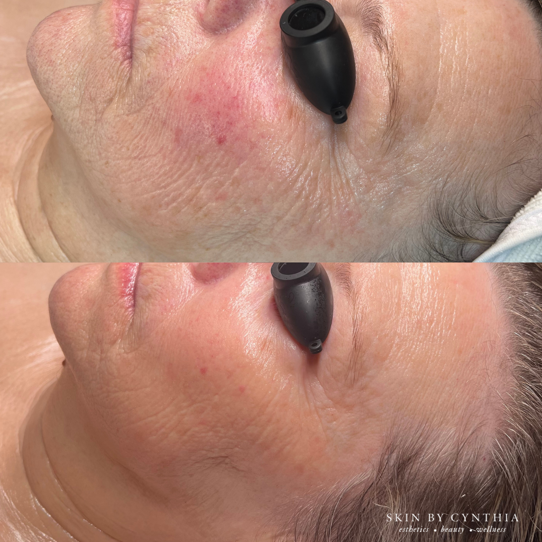 Before and After, Epicutis, Rosacea, Redness, Glass Skin