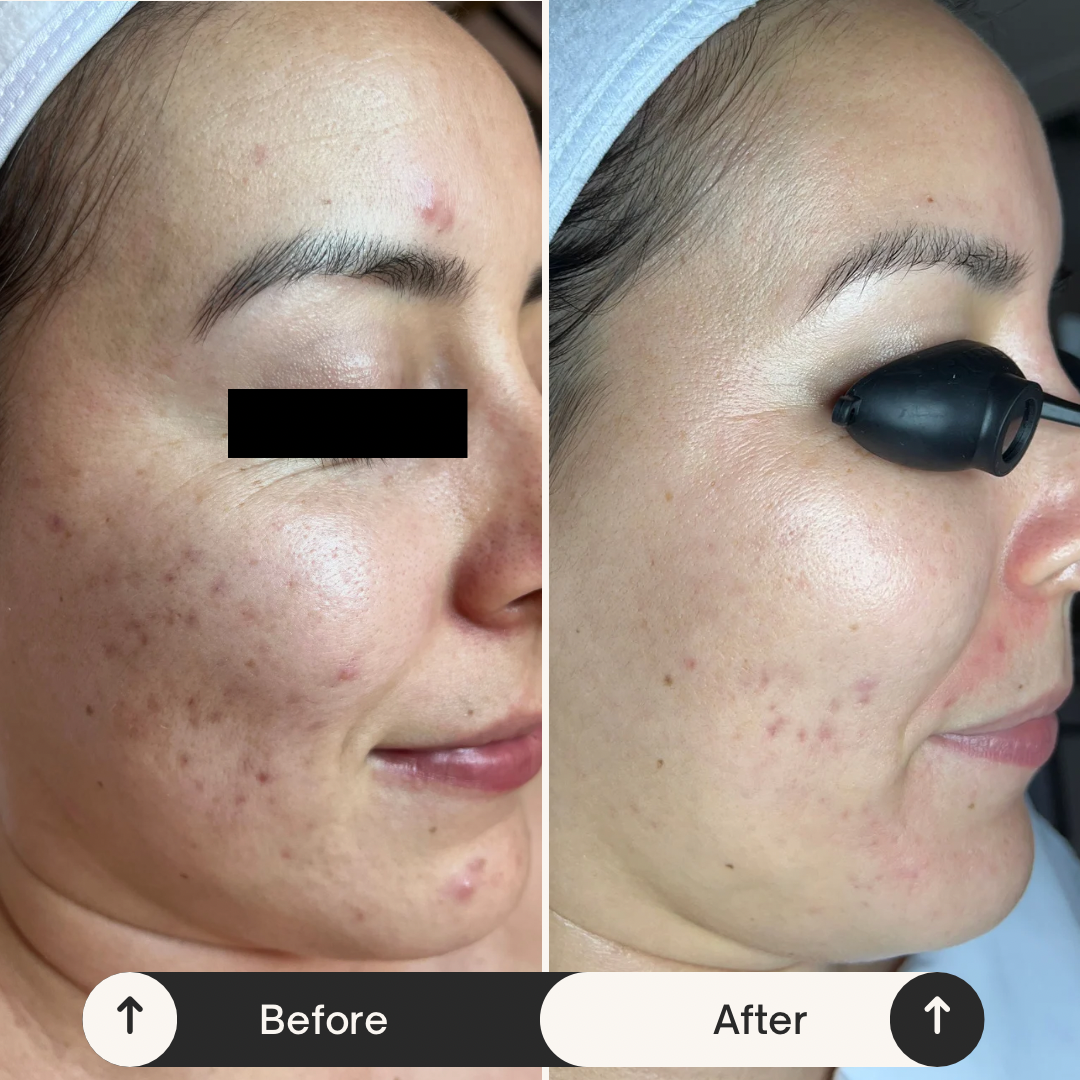 Acne Bootcamp, Post-Inflammatory Erythema, Acne Treatment, Acne Skincare, Before and After, Progress not Perfection, Acne-Prone Skin