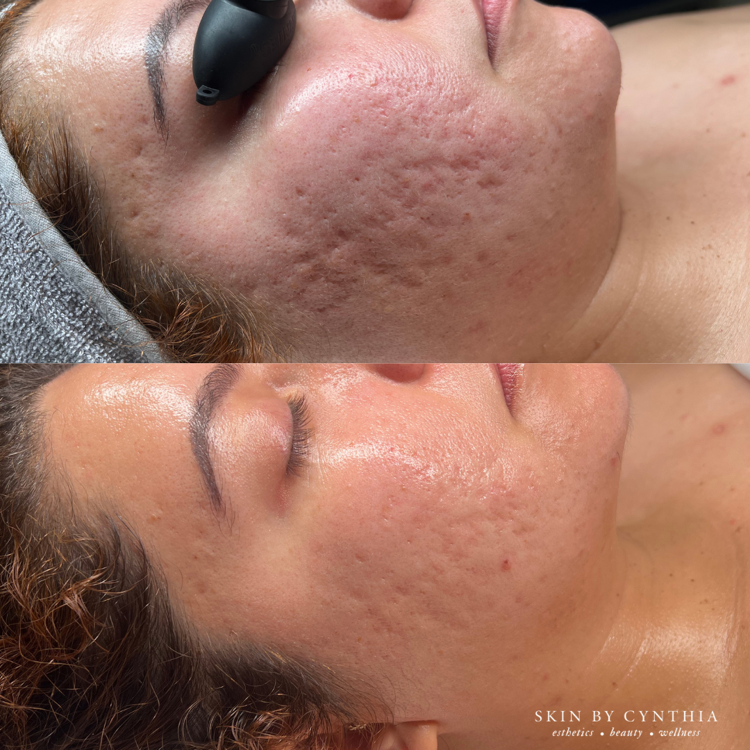 Acne Bootcamp: Click to Learn More