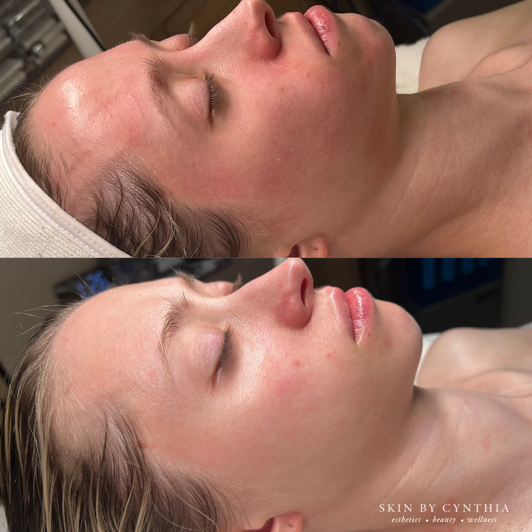 Acne and redness reduction before and after