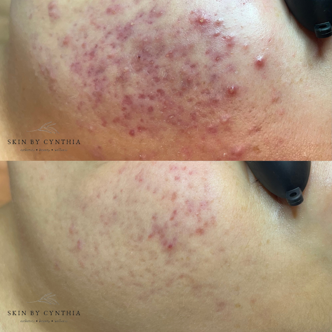 Acne-Prone Skin, Acne Treatment, Acne Skincare Routine, Acne Bootcamp, Acne Specialist, Napa Acne Treatment, Bay Area Acne Treatment